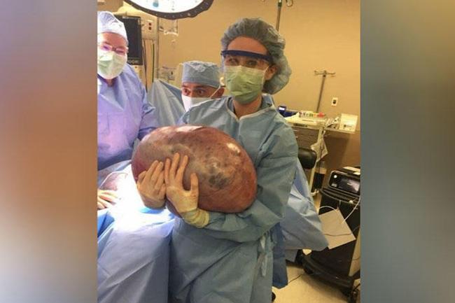 50-pound large cyst removed from Woman’s body