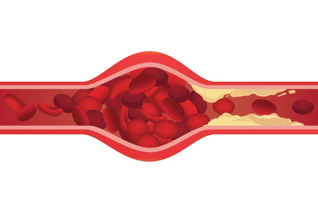 Could it be possible to eliminate clogged arteries?