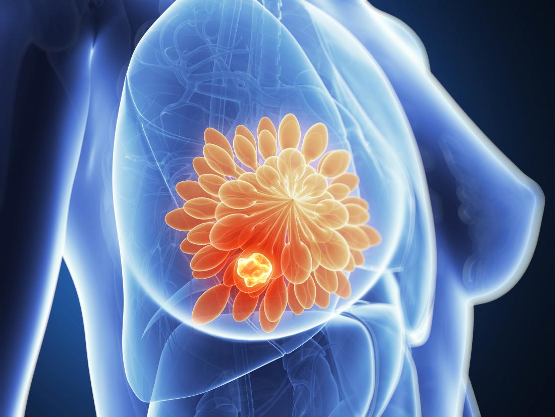 Breast cancer: Tumor growth fueled by bone marrow cells