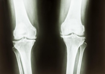 A soy-based diet could help strengthen bones