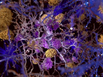 Alzheimer's: How does tau disrupt brain cells?