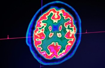 Confusion, seizure, strokes: How COVID-19 may affect the brain