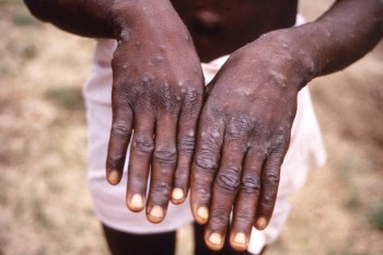 UAE health ministry confirms first case of monkeypox