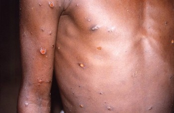 Saudi Arabia reports first monkeypox case