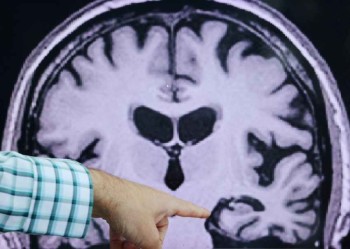 Quest Diagnostics launches Alzheimer's blood test for consumers